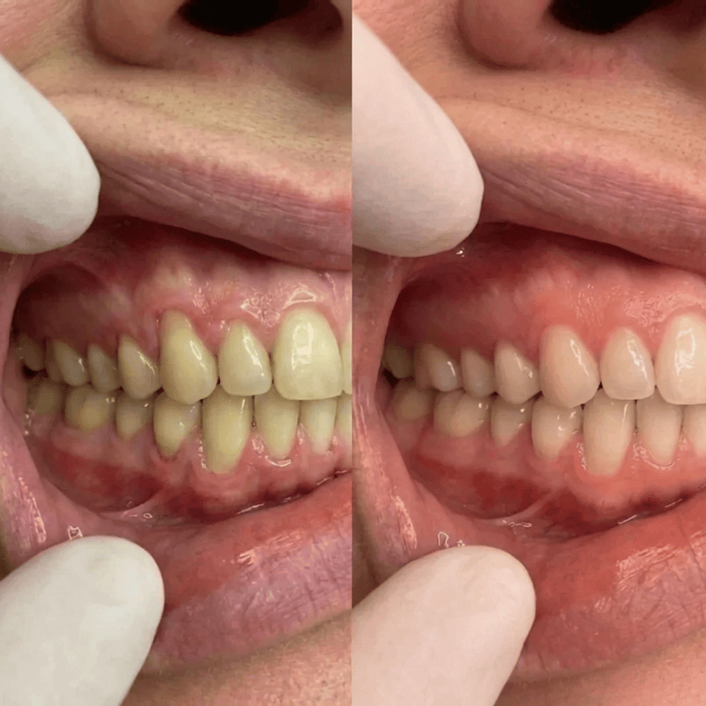 SmyleGum — Gencives saines. Dents blanches. En 2 minutes.