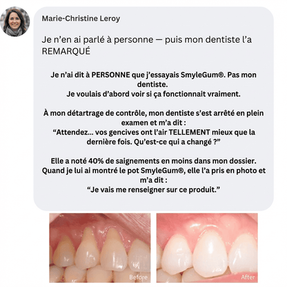 SmyleGum — Gencives saines. Dents blanches. En 2 minutes.