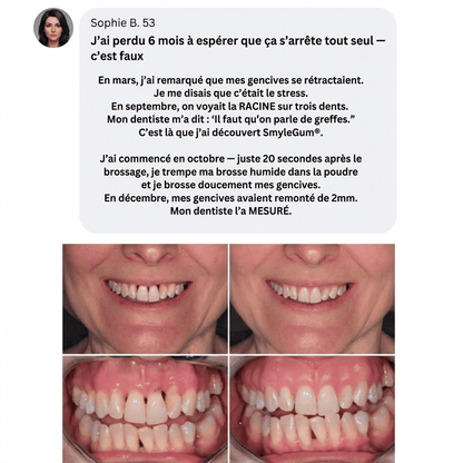 SmyleGum — Gencives saines. Dents blanches. En 2 minutes.