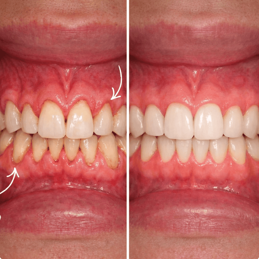 Soins des gencives au collagene